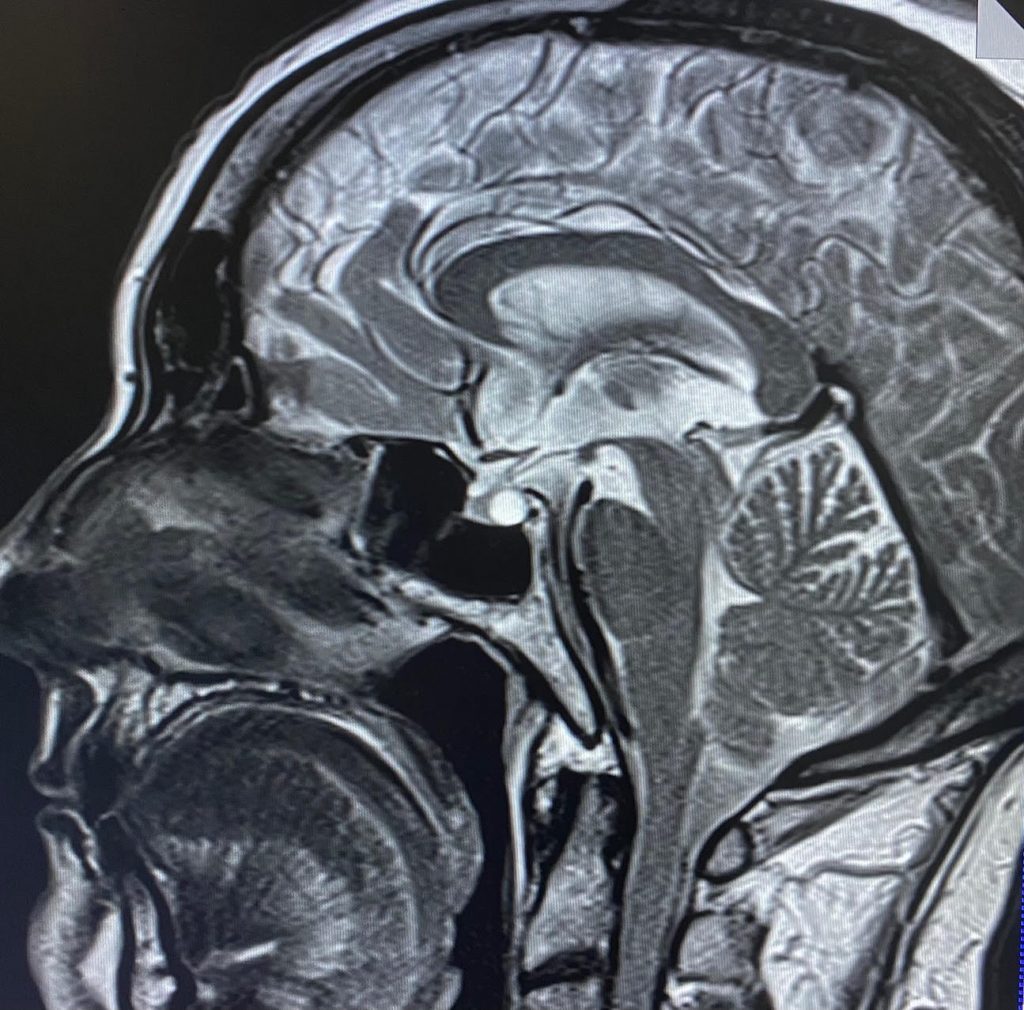 Examen de resonancia magnética de cerebro en clínica de Concepción